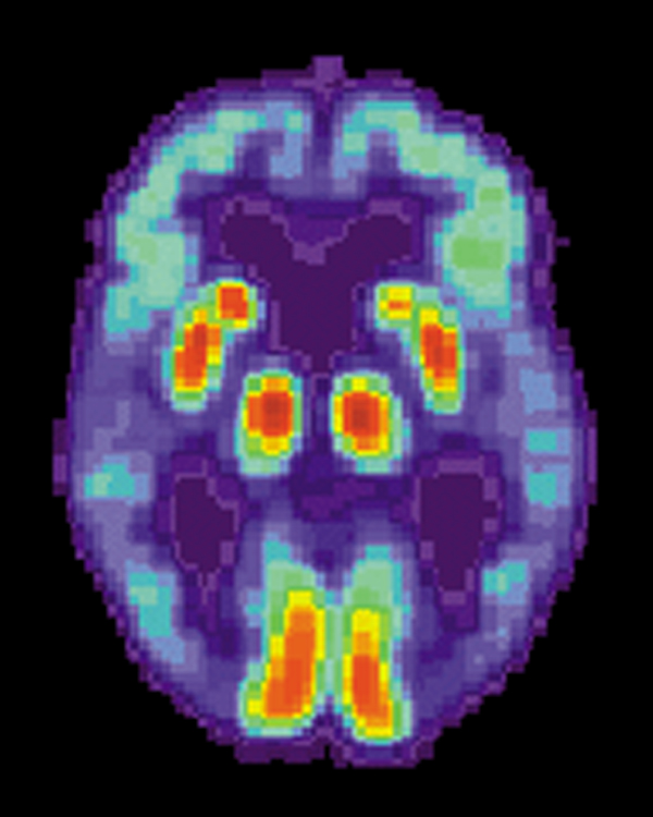 A colored PET scan of a single axial brain slice, with bright red and yellow regions of tracer uptake against a purple background, from a brain affected by Alzheimer's disease
