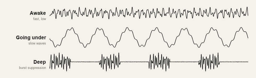 Three EEG traces. Awake is fast and low. Going under is large slow waves. Deep is burst suppression, bursts of activity separated by flat silence.