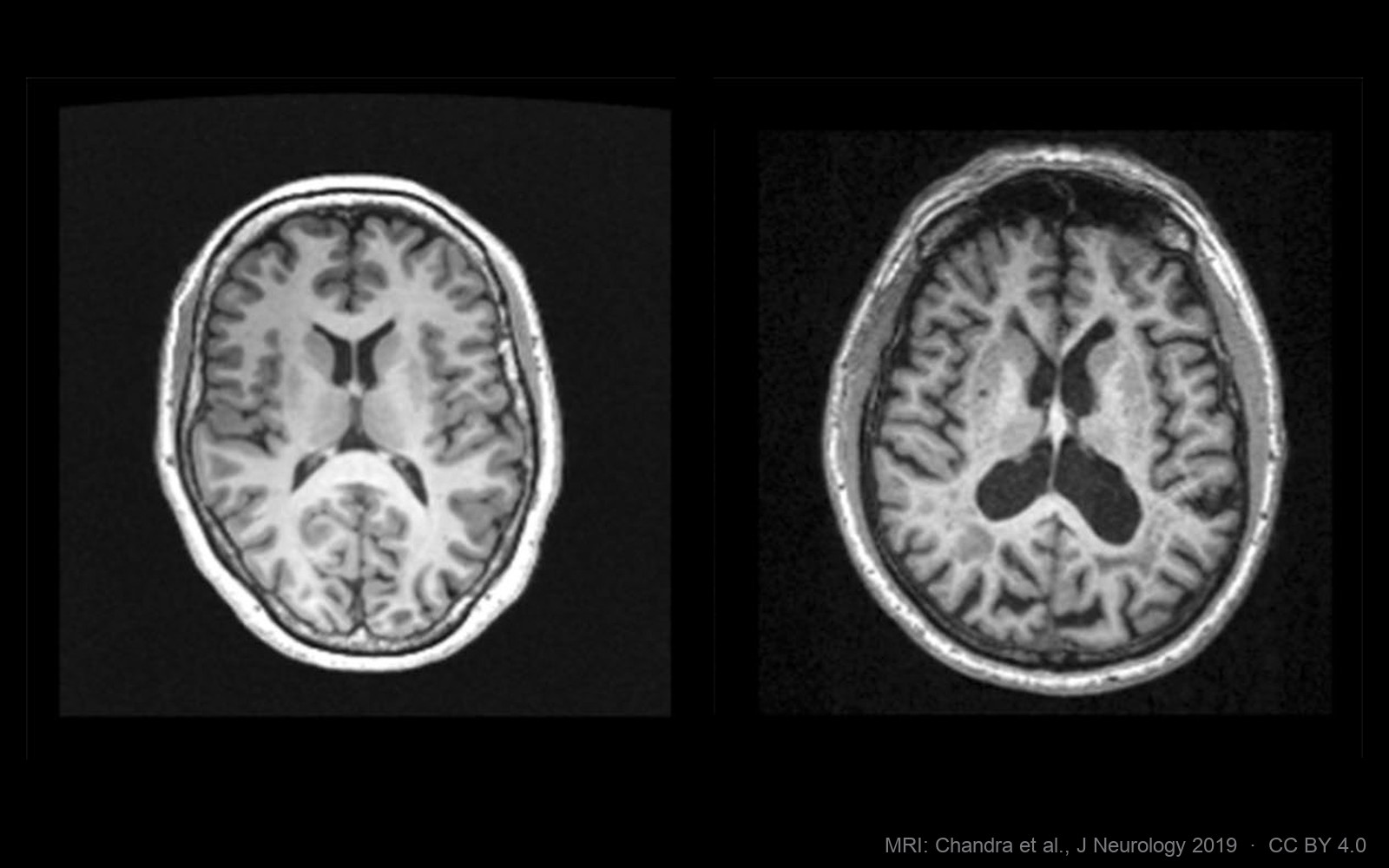 A healthy brain MRI beside an Alzheimer's brain MRI, the ventricles visibly enlarged