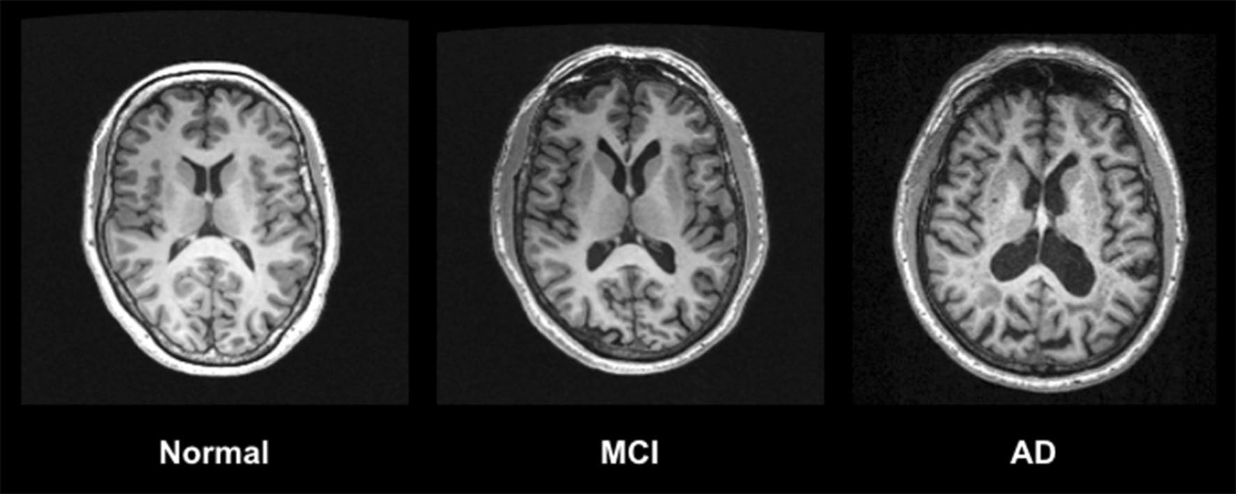 Three axial MRI brain slices side by side, labeled Normal, MCI, and AD, showing the fluid-filled ventricles in the center enlarging and the brain tissue shrinking from left to right